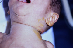 dehiscencia-de-suturas-003