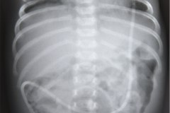 derivacion-ventriculo-peritoneal-1990-000