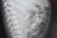 derivacion-ventriculo-peritoneal-1990-001