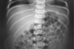 derivacion-ventriculo-peritoneal-000