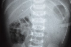 derivacion-ventriculo-peritoneal-001