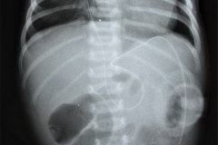 derivacion-ventriculo-peritoneal-002