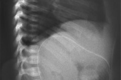 derivacion-ventriculo-peritoneal-003