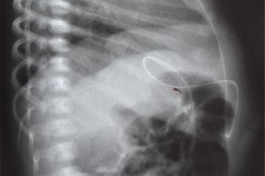 derivacion-ventriculo-peritoneal-004