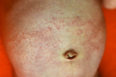 dermatiris-rosasea-000