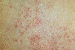 dermatiris-rosasea-001