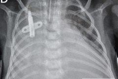 derrame-pleural-der-2005-000