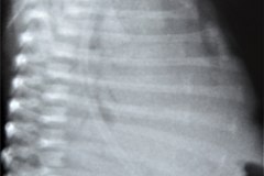 derrame-pleural-der-total-1998-002