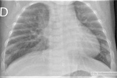 derrame-subpulmonar-izq-2007-000