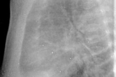 derrame-subpulmonar-izq-2007-001