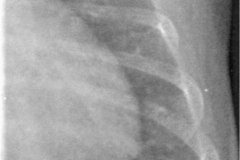 derrame-subpulmonar-izq-2007-002