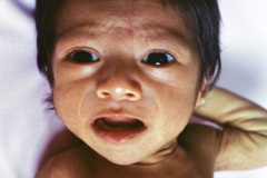 desnutricion-1m-1991-003