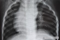 dextrocardia-000