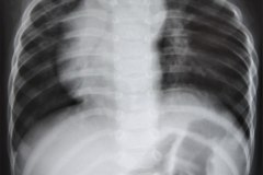 dextrocardia-esplenomegalia-1991-001