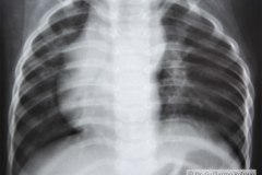 dextrocardia-esplenomegalia-1991-002