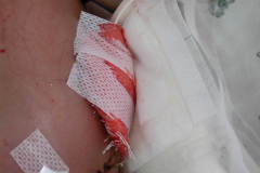 dialisis-peritoneal-via-izq-multiinvadido-2002-000