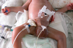 dialisis-peritoneal-via-izq-multiinvadido-2002-002
