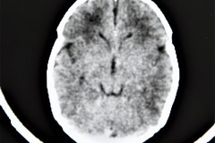 diastasis-suturas-septum-cavum-pellucidum-y-vergae-tac-1992-003