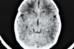 diastasis-suturas-septum-cavum-pellucidum-y-vergae-tac-1992-008