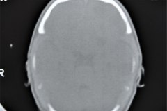 diastasis-suturas-septum-cavum-pellucidum-y-vergae-tac-1992-011