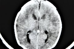 diastasis-suturas-septum-cavum-pellucidum-y-vergae-tac-1992-012