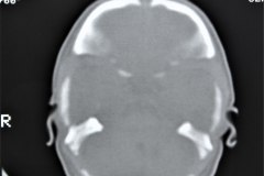 diastasis-suturas-septum-cavum-pellucidum-y-vergae-tac-1992-016