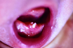 dientes-neonatales-1986-001