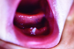 dientes-neonatales-1986-003