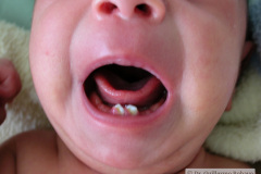 dientes-neonatales-1m-2005-001