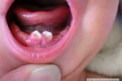 dientes-neonatales-1m-2005-002