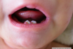 dientes-neonatales-1m-2005-003