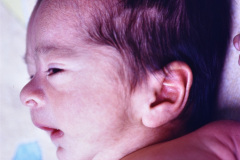 disostosis-cleido-craneal-hipertelorismo-mandibula-afilada-1996-001