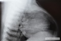 disostosis-cleido-craneal-rn3m1a2a-tac-rn5m1996-003