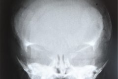 disostosis-cleido-craneal-rn3m1a2a-tac-rn5m1996-005