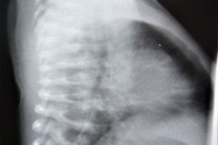 disostosis-cleido-craneal-rn3m1a2a-tac-rn5m1996-007