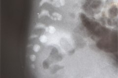 disostosis-cleido-craneal-rn3m1a2a-tac-rn5m1996-008