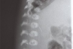 disostosis-cleido-craneal-rn3m1a2a-tac-rn5m1996-009