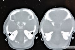 disostosis-cleido-craneal-rn3m1a2a-tac-rn5m1996-011