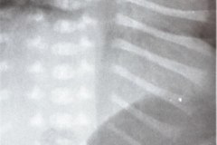 disostosis-cleido-craneal-rn3m1a2a-tac-rn5m1996-012