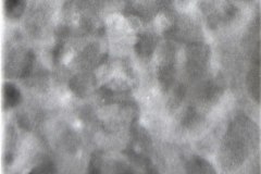 disostosis-cleido-craneal-rn3m1a2a-tac-rn5m1996-013