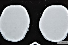 disostosis-cleido-craneal-rn3m1a2a-tac-rn5m1996-014