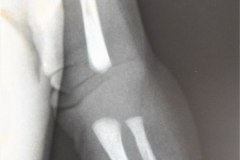 disostosis-cleido-craneal-rn3m1a2a-tac-rn5m1996-015
