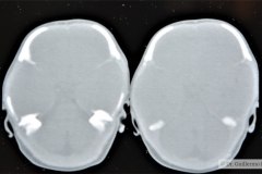 disostosis-cleido-craneal-rn3m1a2a-tac-rn5m1996-016