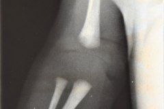 disostosis-cleido-craneal-rn3m1a2a-tac-rn5m1996-017