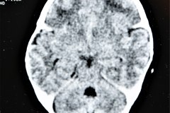disostosis-cleido-craneal-rn3m1a2a-tac-rn5m1996-018