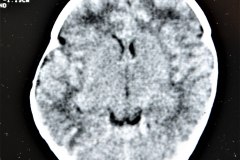 disostosis-cleido-craneal-rn3m1a2a-tac-rn5m1996-019