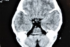 disostosis-cleido-craneal-rn3m1a2a-tac-rn5m1996-020
