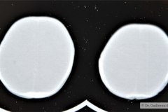 disostosis-cleido-craneal-rn3m1a2a-tac-rn5m1996-021