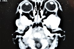 disostosis-cleido-craneal-rn3m1a2a-tac-rn5m1996-022