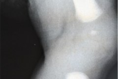 disostosis-cleido-craneal-rn3m1a2a-tac-rn5m1996-025
